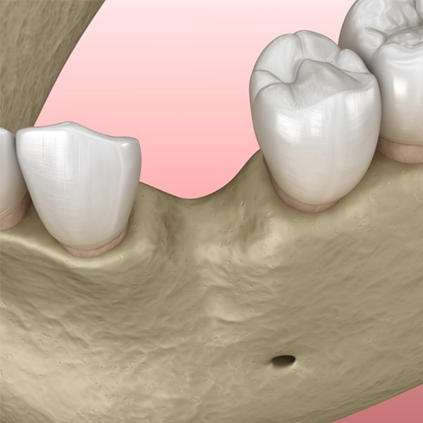 Bone graft Photo 1