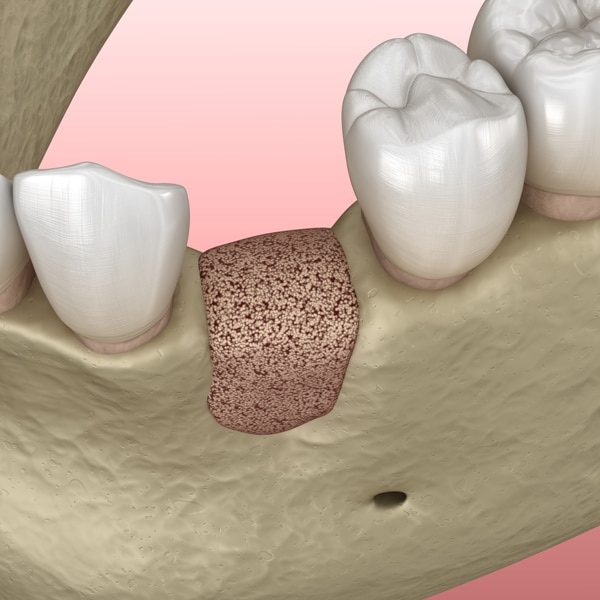 Bone graft Photo 2