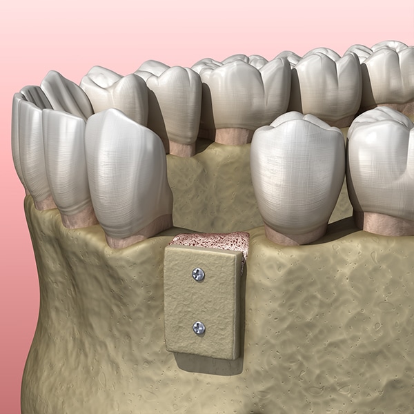 Bone graft Photo 3