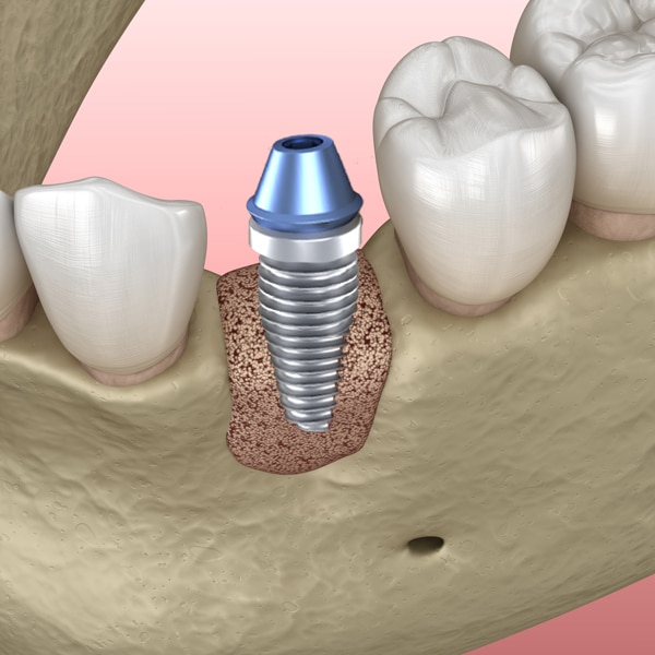 Bone graft Photo 4